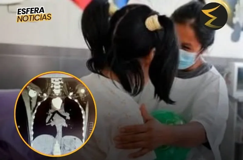 Médicos salvan a niña de chachapoyas tras extraerle una piedra del esófago